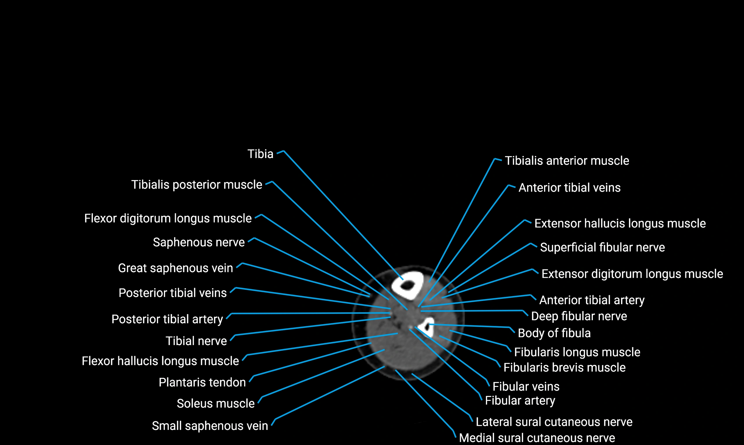 CT lower limb axial cross sectional anatomy labelled image 136 (2).webp